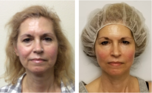 NON SURGICAL FACE LIFT FARMINGTON CT