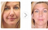 Non Surgical Facelift Glastonbury CT