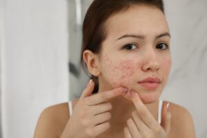 Acne Care Treatments Farmington