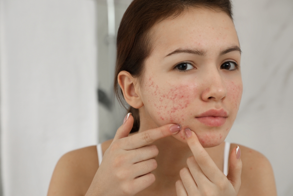 Acne Care Treatments Farmington